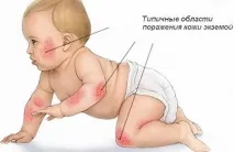 Екзема у дітей симптоми та лікування на голові та грудях у новонародженого та немовля симптоми