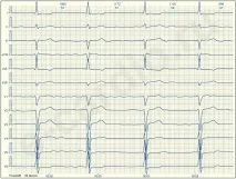 E-Cardio Фібриляція передсердь видно