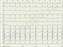 E-Cardio Фібриляція передсердь видно