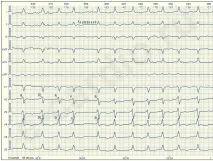 E-Cardio Фібриляція передсердь e-cardio