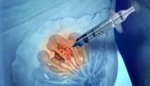 Фіброма грудної залози у жінок симптоми, лікування, видалення грудної