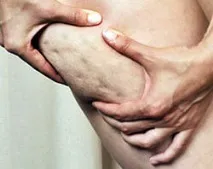Як позбутися целюліту самостійно? самостійно