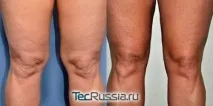 Як прибрати жир з колін – вправи чи операції Фото результатів прибрати