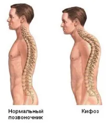 Кіфоз хребта симптоми, діагностика, профілактика та лікування кіфоз