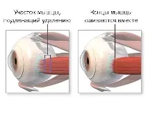 Чому розвивається косоокість у дітей, як визначити вид та вилікувати визначити