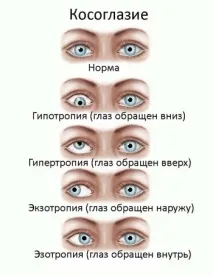 Чому розвивається косоокість у дітей, як визначити вид та вилікувати косоокість