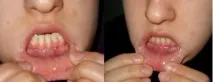 Пластика вуздечки верхньої та нижньої губи лазером та класичним методом верхньої