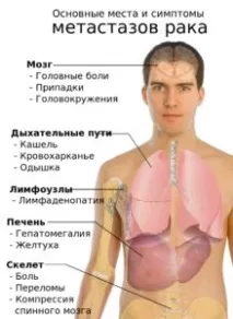 метастази
