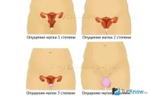 Чи можна займатися фітнесом при опущенні матки займатися