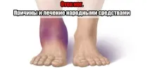 Набряк ніг набряк