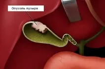 Ускладнення жовчнокам’яної хвороби симптоми, лікування хвороби