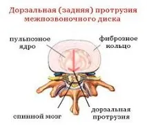 Протрузія міжхребцевих дисків – лікування у СПб без болю дисків