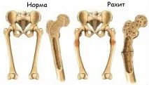 Рахіт - причини, симптоми, лікування у немовлят, дітей та підлітків симптоми
