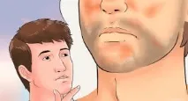 себорейна