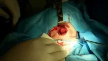 Середня кіста шиї середня