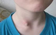 Середня кіста шиї серединної кісти