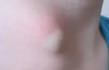 Середня кіста шиї серединної