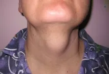 Середня кіста шиї середня