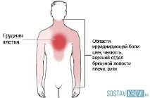 Стенокардія причини, симптоми, перша допомога, лікування та профілактика причини