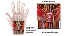 Тендовагініт променево-зап’ясткового суглоба причини, симптоми, види та лікування променево-зап