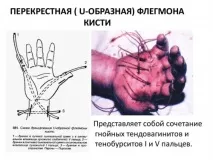 Тендовагініт променево-зап’ясткового суглоба причини, симптоми, види та лікування променево-зап
