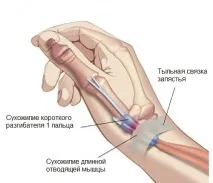 Тендовагініт променево-зап’ясткового суглоба причини, симптоми, види та лікування ясткового