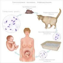 Токсоплазмоз при вагітності - симптоми, діагностика та лікування симптоми