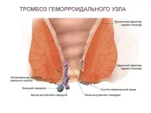 Виділення із заднього проходу причини патології організму виділення
