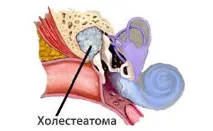 холестеатом