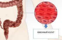 Simptomele colitei ulcerative ale intestinului, diagnosticul bolii - tratamentul bolii în clinica „Naran”