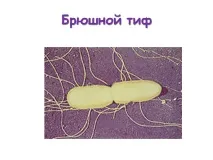 Черевний тиф - Презентація 18406-36 віку