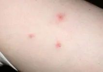 Що робити при укусах домашніх клопів? домашніх