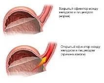 Що допомагає від печії в домашніх умовах швидко та ефективно домашніх