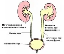 Дитяча урологія лапароскопічна пієлопластика, ціни, відгуки ціни