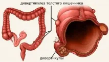 Дивертикульоз товстого кишечника симптоми та лікування у дорослих дивертикульоз