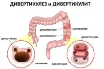 Дивертикульоз товстого кишечника симптоми та лікування у дорослих кишечника
