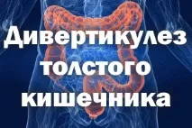 Дивертикульоз товстого кишечника симптоми та лікування у дорослих товстого