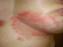 симптоми