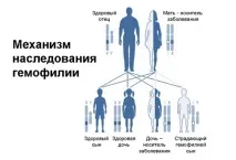 Гемофілія типу A, B і C - симптоми, причини, лікування, діагностика у жінок, чоловіків та дітей симптоми