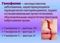 Гемофілія типу A, B і C - симптоми, причини, лікування, діагностика у жінок, чоловіків та дітей гемофілія
