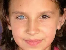 Гетерохромія або різний колір очей у людей. людей