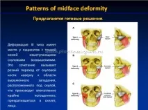 Гур’янов Андрій Станіславович - Імпланти середньої зони обличчя станіславович