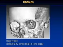 Гур’янов Андрій Станіславович - Імпланти середньої зони обличчя станіславович