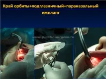 Гур’янов Андрій Станіславович - Імпланти середньої зони обличчя андрій