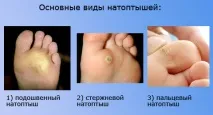 Які види (типи) натоптишів існують типи