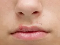 герпесу
