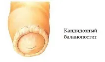 Як лікувати кандидозний баланіт та баланопостит у чоловіків – що за хвороби, симптоми, фото, баланопостит