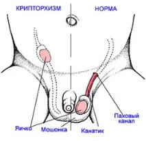 крипторхизъм