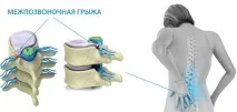 Лікування грижі за кордоном, Операції при лікуванні грижі за кордоном кордоном