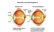 Лікування міопії у дітей Лікування дитини - дитячі хвороби, консультації, досвід міопії